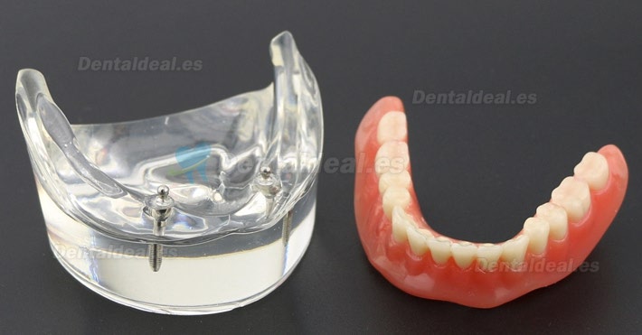 Dental Dientes inferiores Modelo de sobredentadura 2 Implantes Demostración Modelo 6002 01